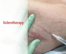 sclerotherapy sclerotherapy