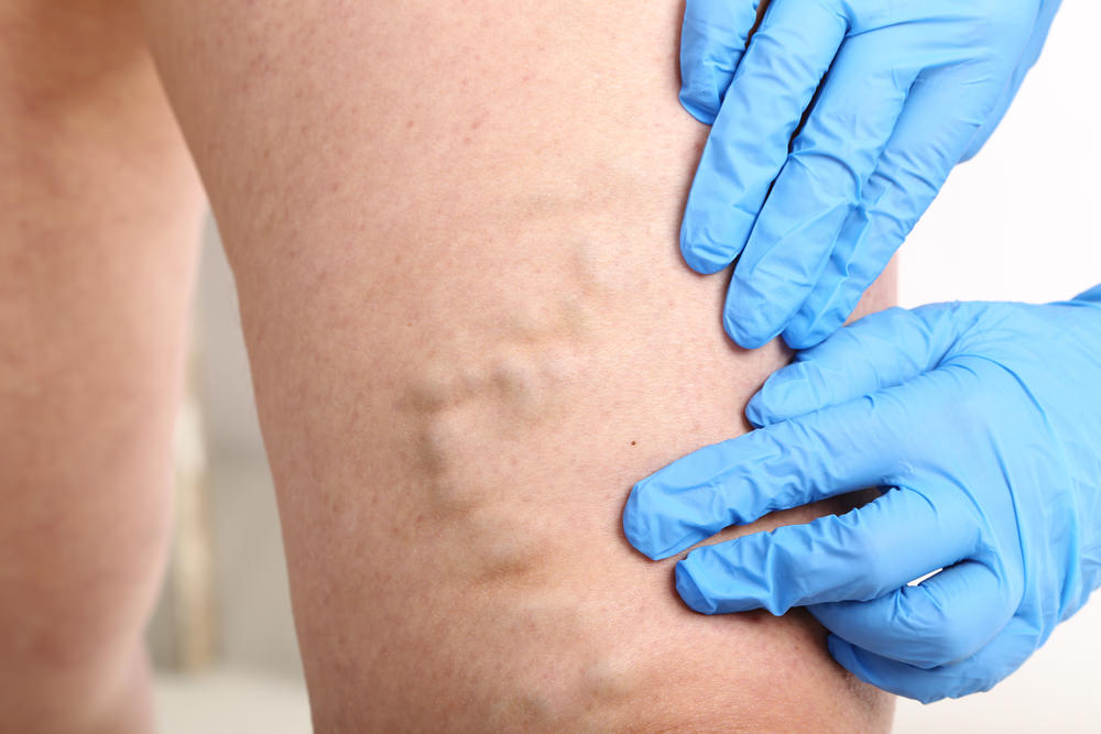 /varicose-veins /varicose-veins