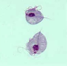 Trichomoniasis