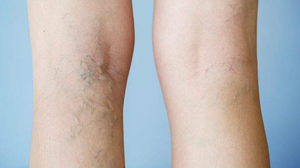 varicose veins varicose-veins2