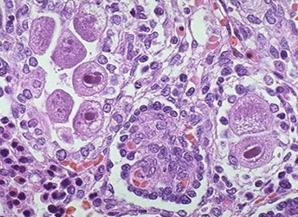 Cytomegalovirus Cytomegalovirus