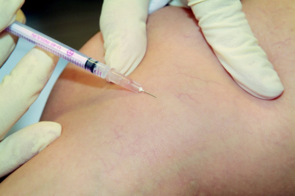 /second_degree-veins /second_degree-veins