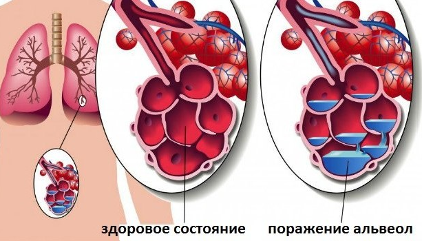 Пневмония Пневмония