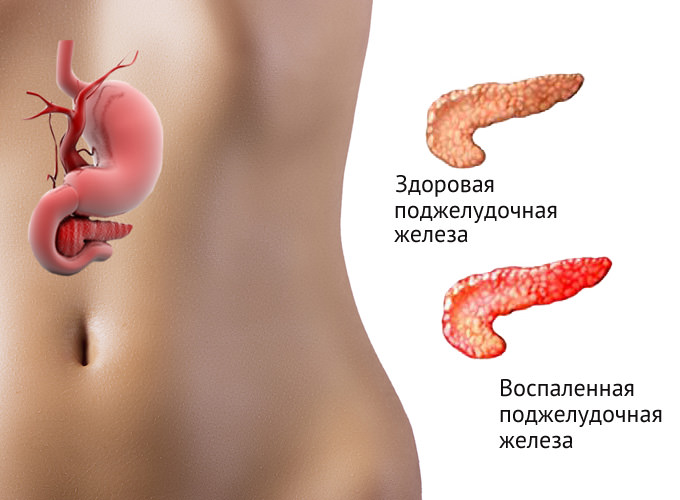 Пакреатит.jpg терапия