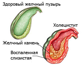 Холецистит.jpg Холецистит.jpg