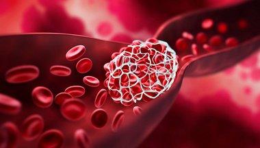 thrombosis_2.jpg