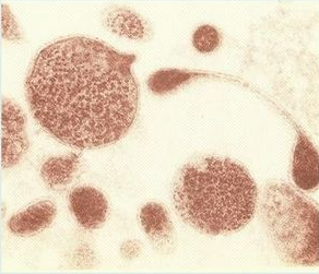 ureaplasmosis ureaplasmosis