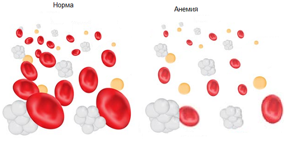 Anemia.png Anemia.png